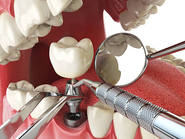 Best Broken or Cracked Tooth Emergency Dentist in Cheyenne, WY